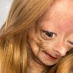 progeria-adalia-rose